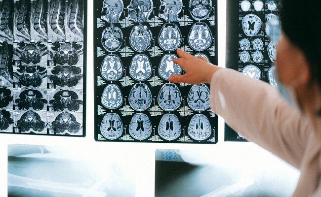 El lecanemab y su controversia: ¿nuevo horizonte en la lucha contra el Alzheimer?