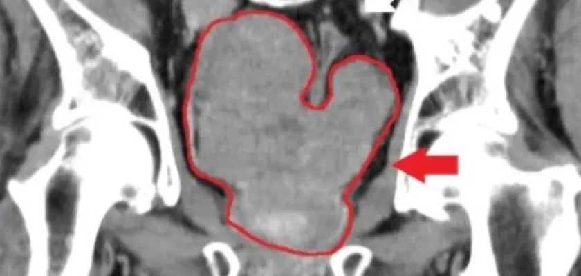 Separar la comida del cáncer: nuevos avances en el tratamiento del cáncer de próstata