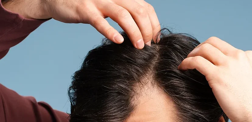 Nuevos fármacos contra la obesidad: ¿la pérdida de peso vale la caída del cabello?